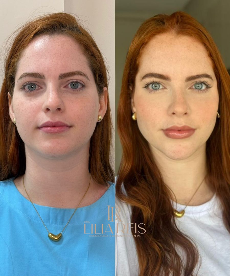 Antes e depois 1