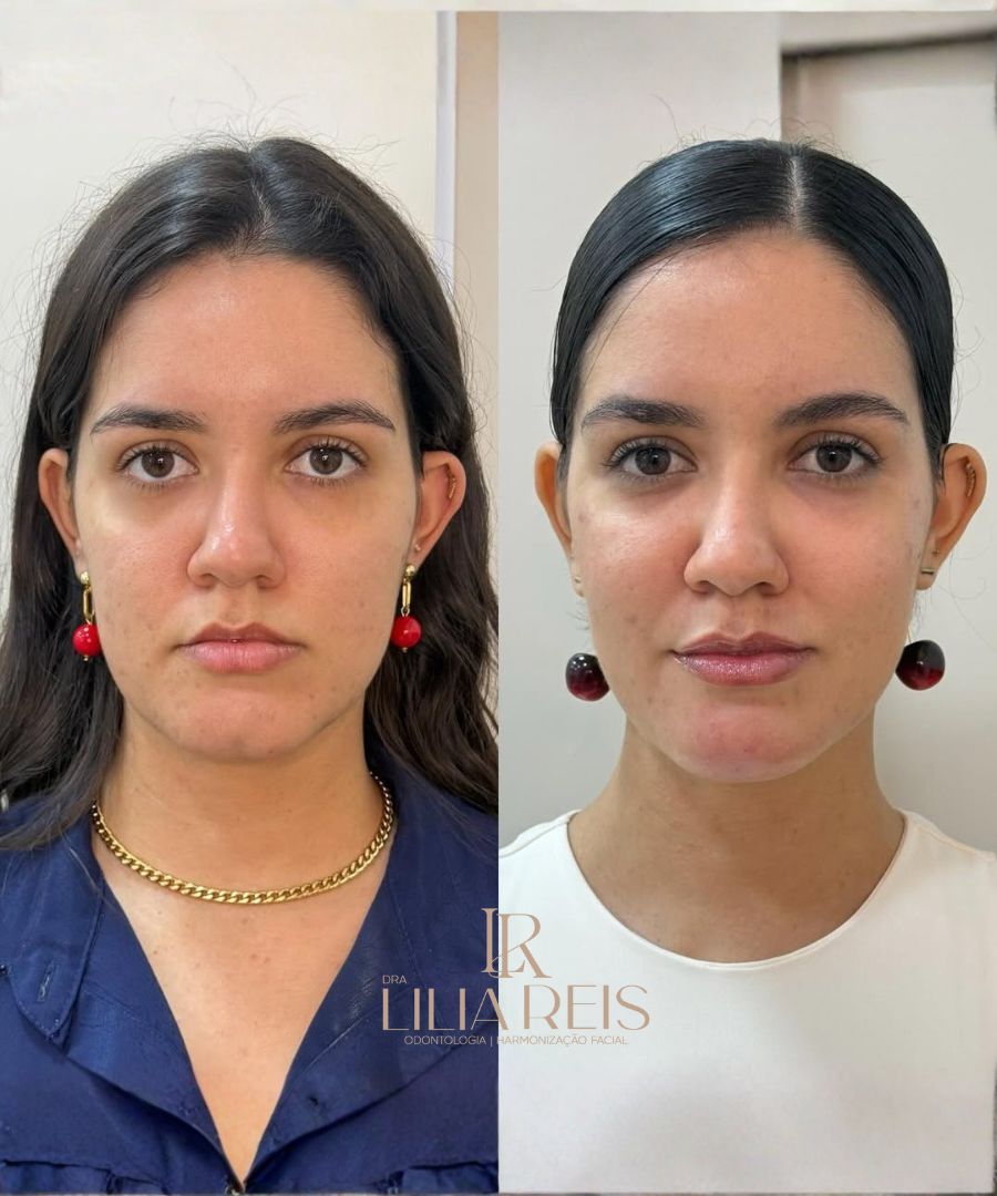 Antes e depois 2