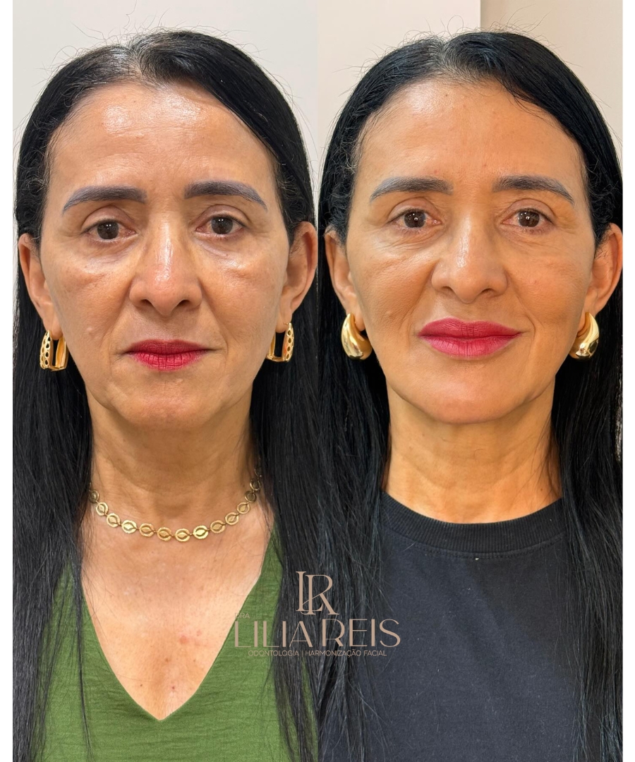 Antes e depois 3