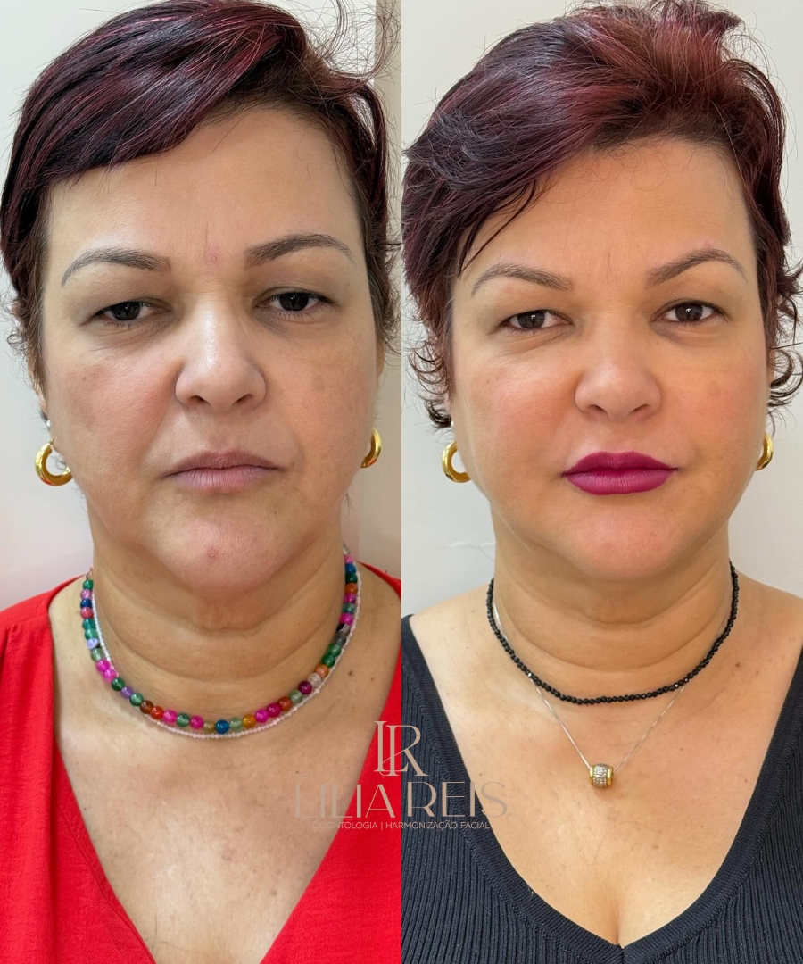 Antes e depois 4